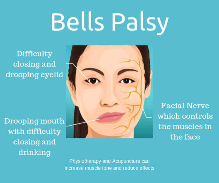 Using Massage Therapy to Treat Bell's Palsy - Medical Massage