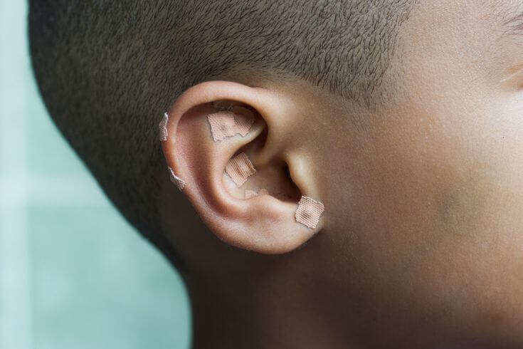 Where to Place Ear Seeds for Weight Loss