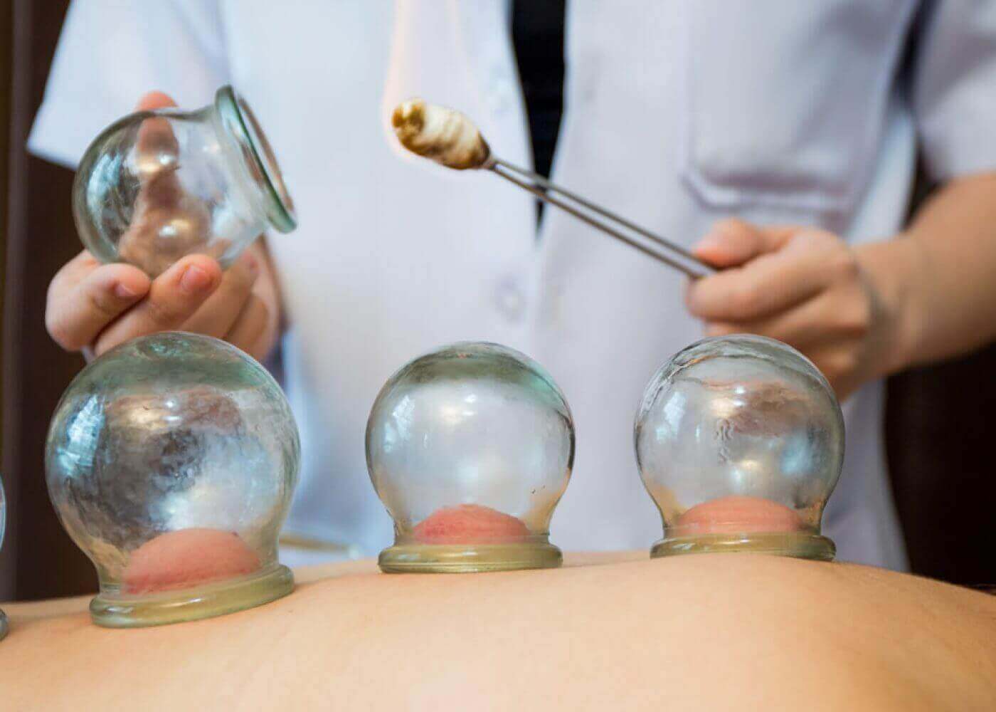 Cupping Therapy: Benefits And What To Expect | Shanghai Medical Clinic